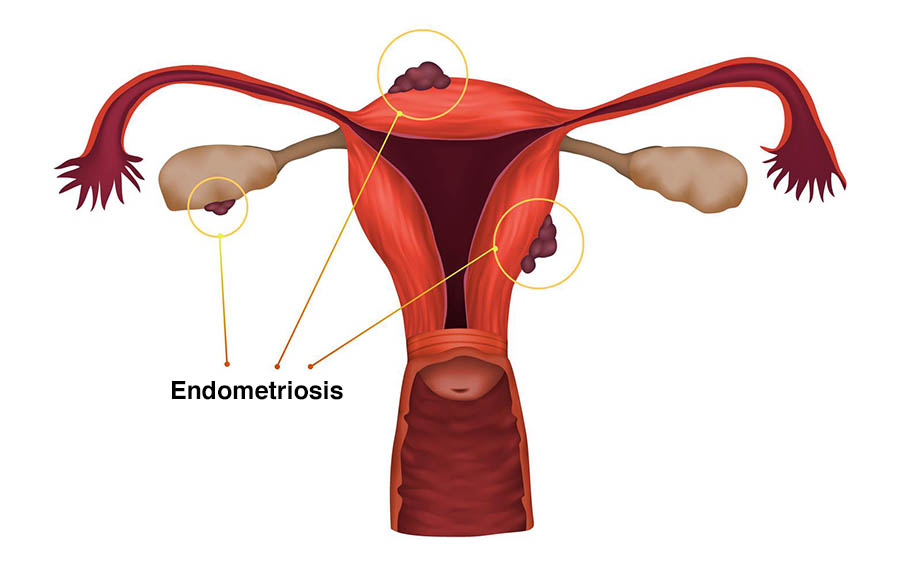 What is Endometriosis? Symptoms, Treatments and Risk Factors