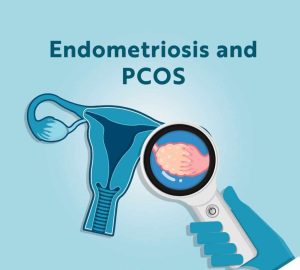 What are the causes of endometriosis vs. PCOS?