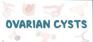 What are the complications of an ovarian cyst?