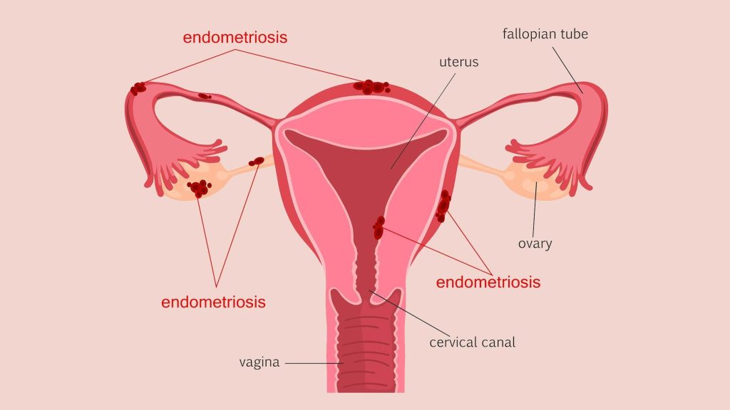 Endometriosis Symptoms