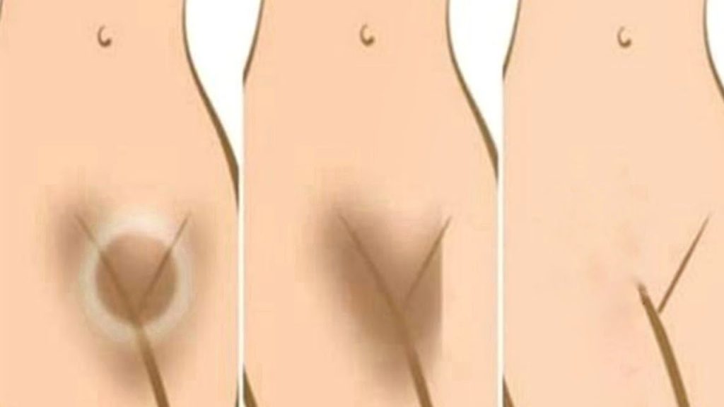How to Prevent Vaginal Darkening