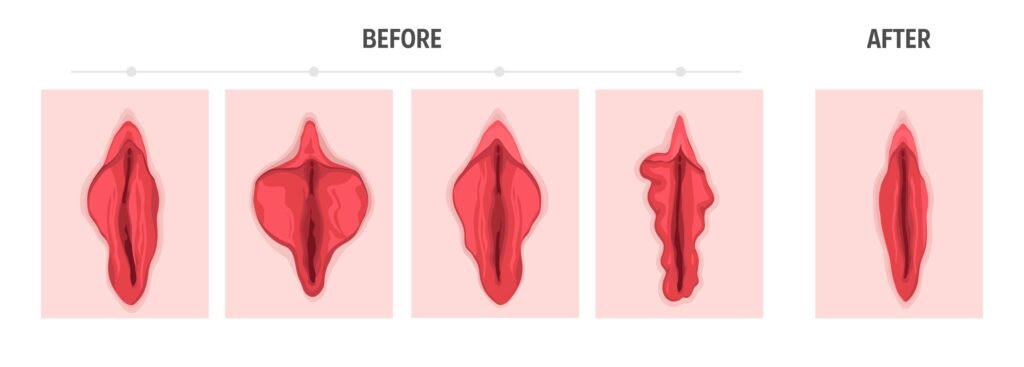 Large Labia Treatment