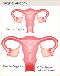 Genital Atrophy: Exploring the Condition