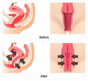 The Vaginal Surgery Procedure: What to Expect